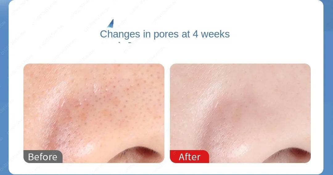 Xiaomi DOCO Ultra-Micro Bubble Pore Vacuum Cleaner – Electric Acne and Blackhead Remover - My Store
